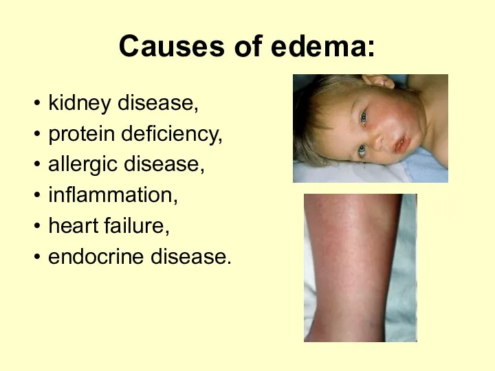 Causes of edema: kidney disease, protein deficiency, allergic disease, inflammation, heart failure, endocrine disease.