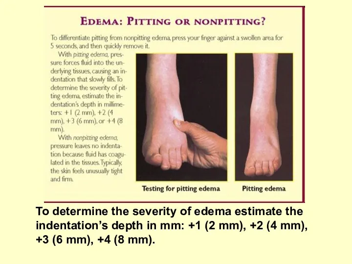 To determine the severity of edema estimate the indentation’s depth