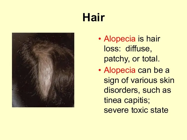 Hair Alopecia is hair loss: diffuse, patchy, or total. Alopecia