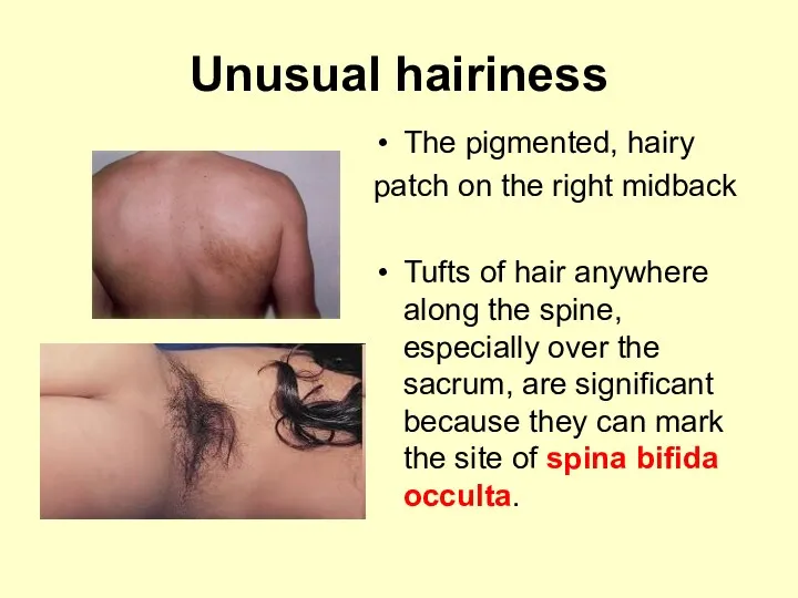 Unusual hairiness The pigmented, hairy patch on the right midback