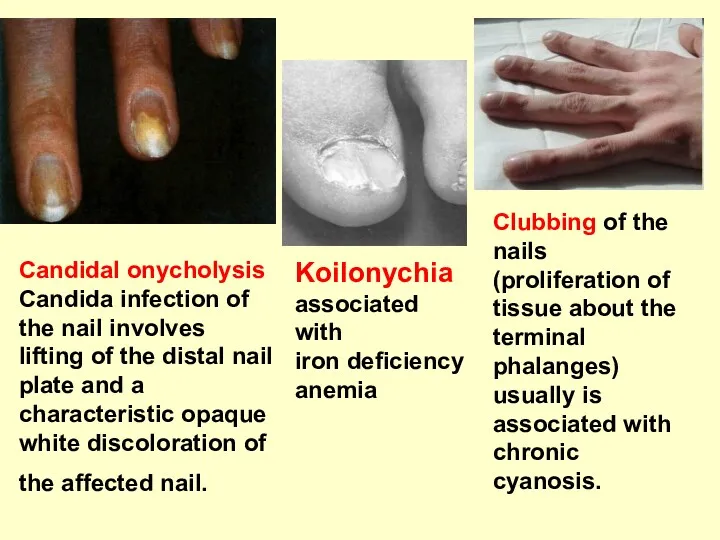 Candidal onycholysis Candida infection of the nail involves lifting of