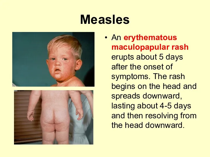 Measles An erythematous maculopapular rash erupts about 5 days after