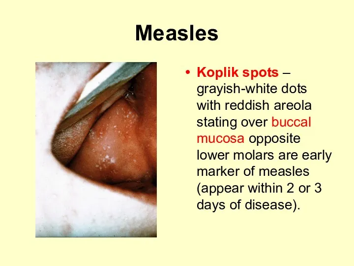 Measles Koplik spots – grayish-white dots with reddish areola stating