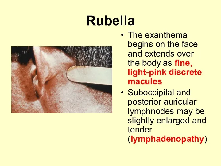 Rubella The exanthema begins on the face and extends over