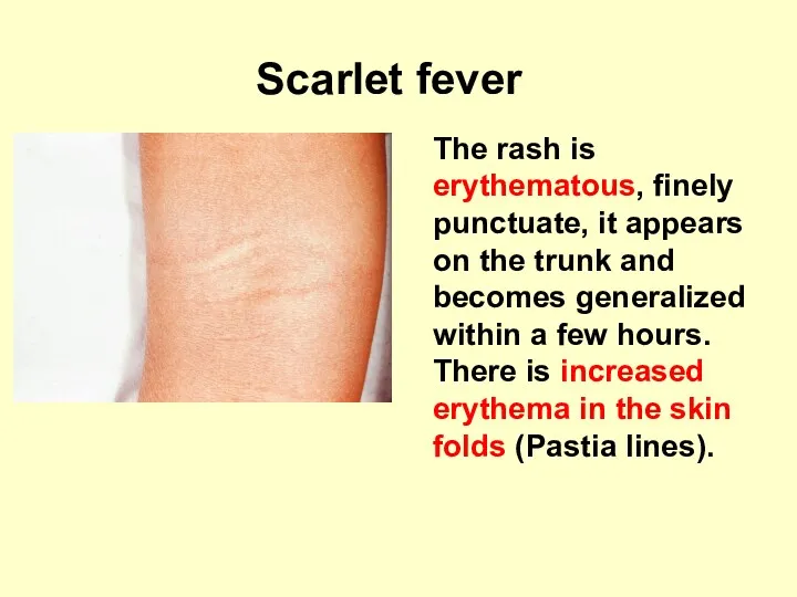 Scarlet fever The rash is erythematous, finely punctuate, it appears