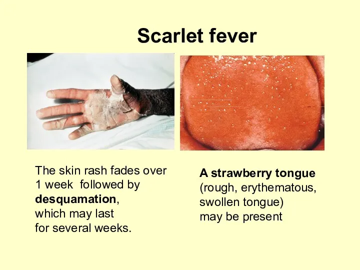 Scarlet fever The skin rash fades over 1 week followed