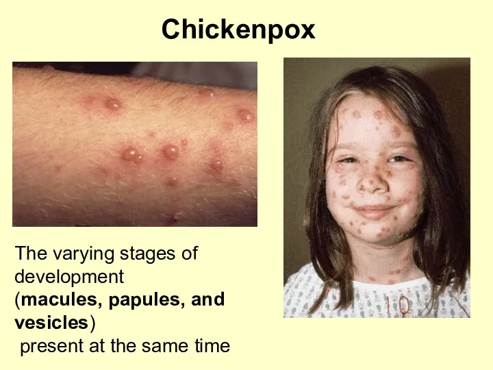 Chickenpox The varying stages of development (macules, papules, and vesicles) present at the same time