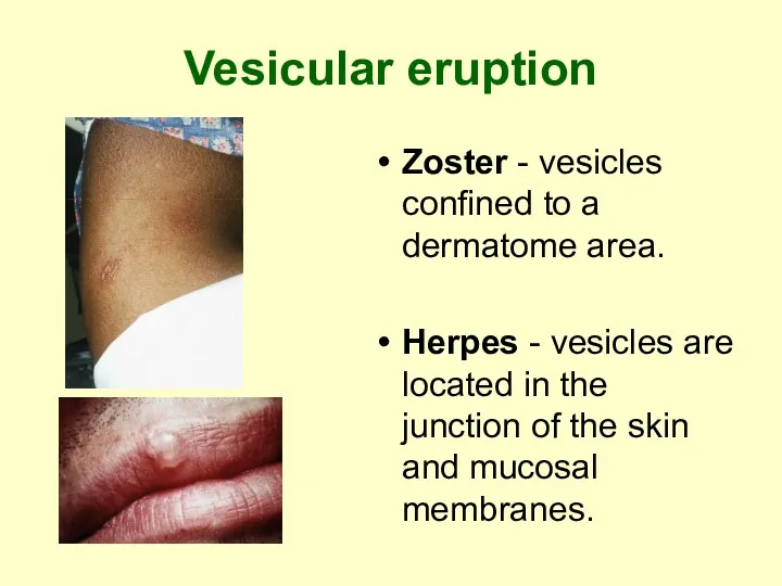 Vesicular eruption Zoster - vesicles confined to a dermatome area.