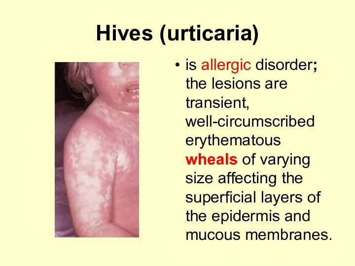 Hives (urticaria) is allergic disorder; the lesions are transient, well-circumscribed