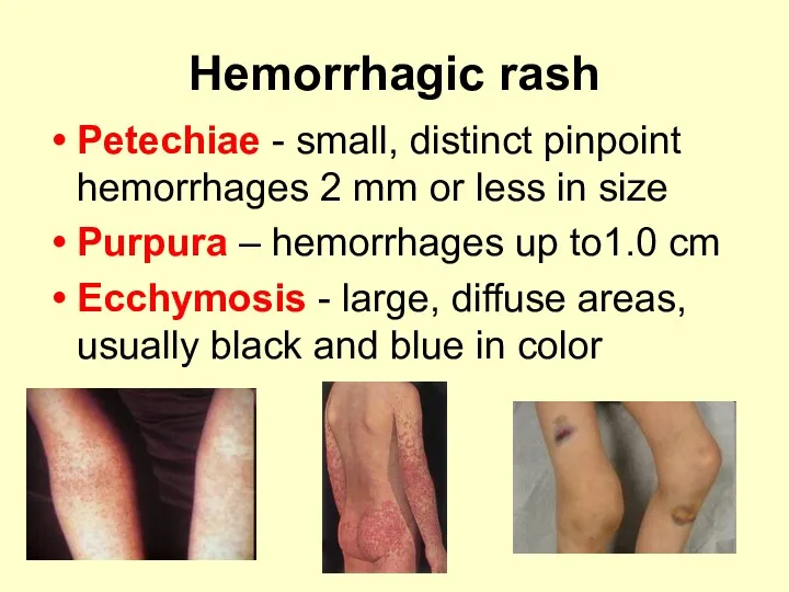 Hemorrhagic rash Petechiae - small, distinct pinpoint hemorrhages 2 mm