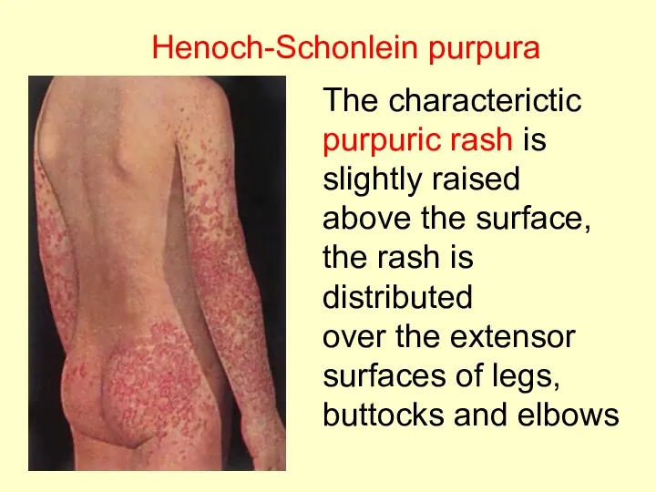 Henoch-Schonlein purpura The characterictic purpuric rash is slightly raised above