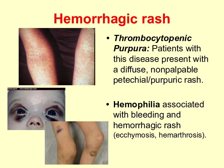 Hemorrhagic rash Thrombocytopenic Purpura: Patients with this disease present with