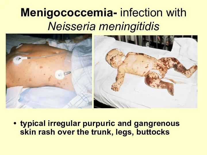 Menigococcemia- infection with Neisseria meningitidis typical irregular purpuric and gangrenous