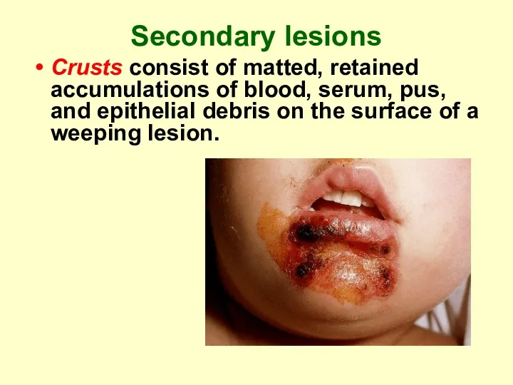 Secondary lesions Crusts consist of matted, retained accumulations of blood,