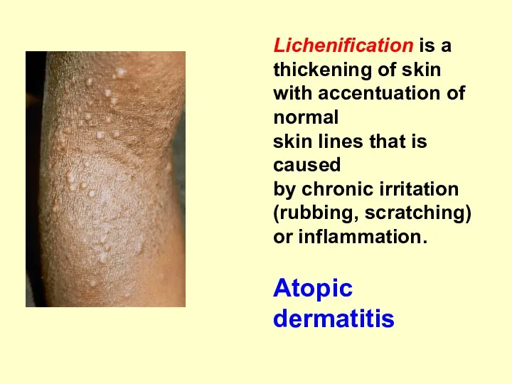 Lichenification is a thickening of skin with accentuation of normal