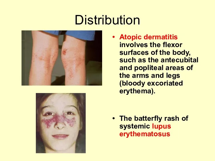 Distribution Atopic dermatitis involves the flexor surfaces of the body,