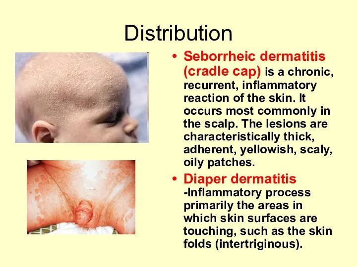 Distribution Seborrheic dermatitis (cradle cap) is a chronic, recurrent, inflammatory