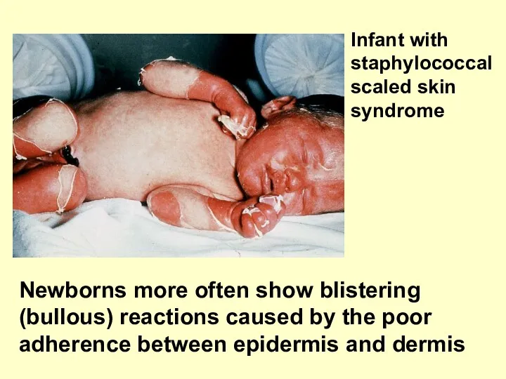 Newborns more often show blistering (bullous) reactions caused by the