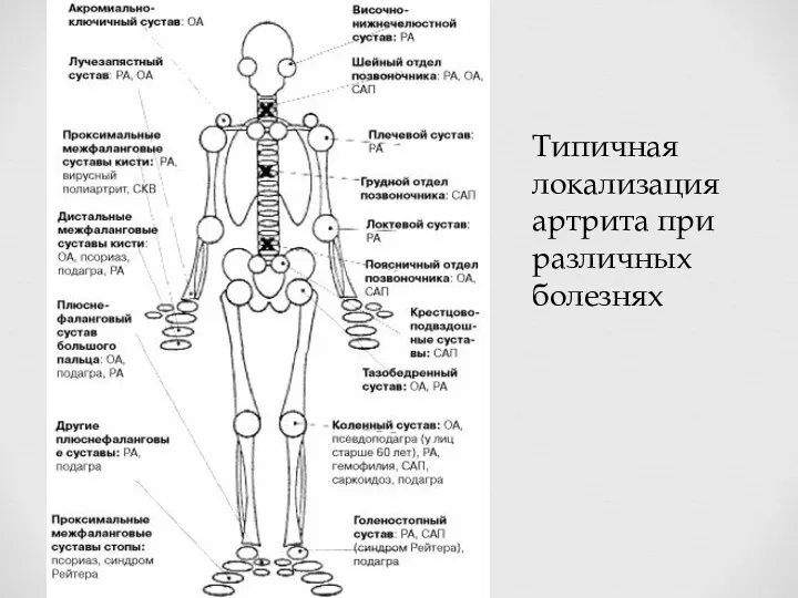 Типичная локализация артрита при различных болезнях