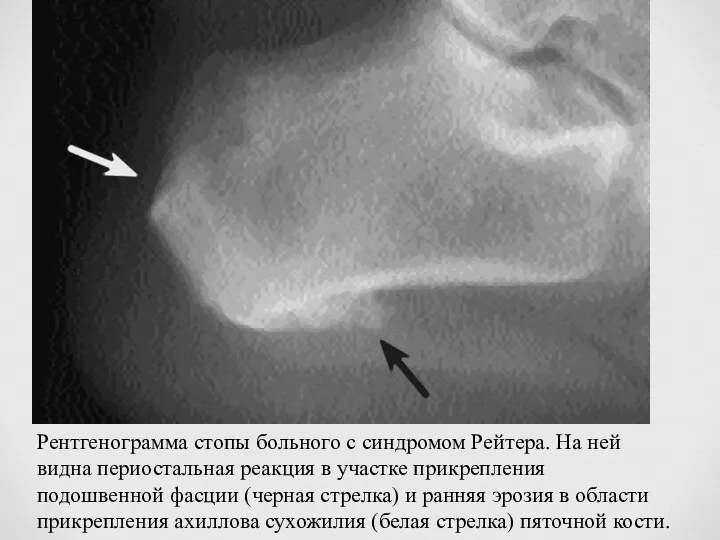 Рентгенограмма стопы больного с синдромом Рейтера. На ней видна периостальная