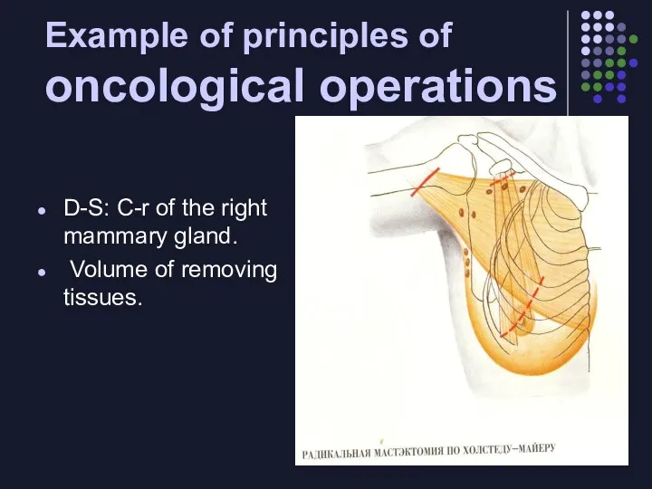 Example of principles of oncological operations D-S: С-r of the right mammary gland.
