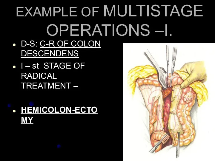 EXAMPLE OF MULTISTAGE OPERATIONS –I. D-S: С-R OF COLON DESCENDENS I – st