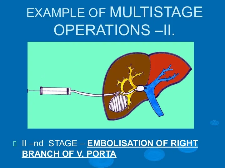 EXAMPLE OF MULTISTAGE OPERATIONS –II. II –nd STAGE – EMBOLISATION OF RIGHT BRANCH OF V. PORTA