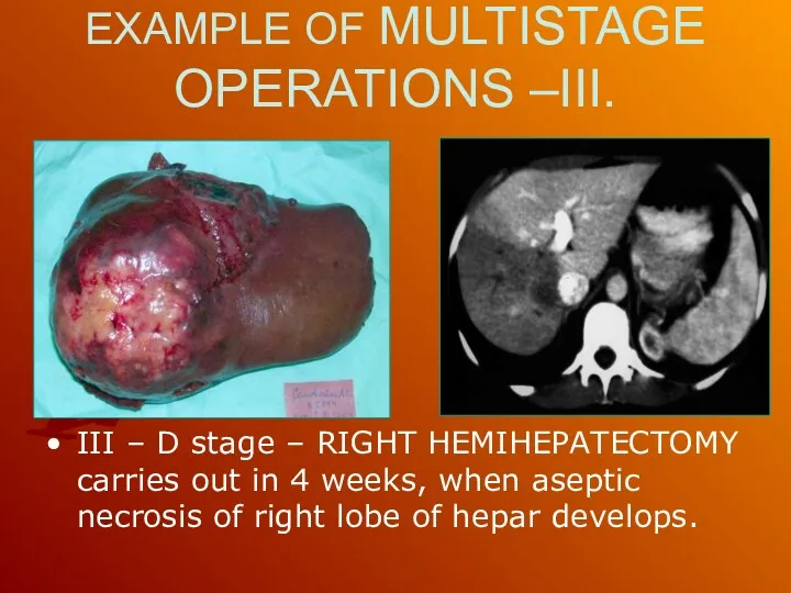 EXAMPLE OF MULTISTAGE OPERATIONS –III. III – D stage – RIGHT HEMIHEPATECTOMY carries