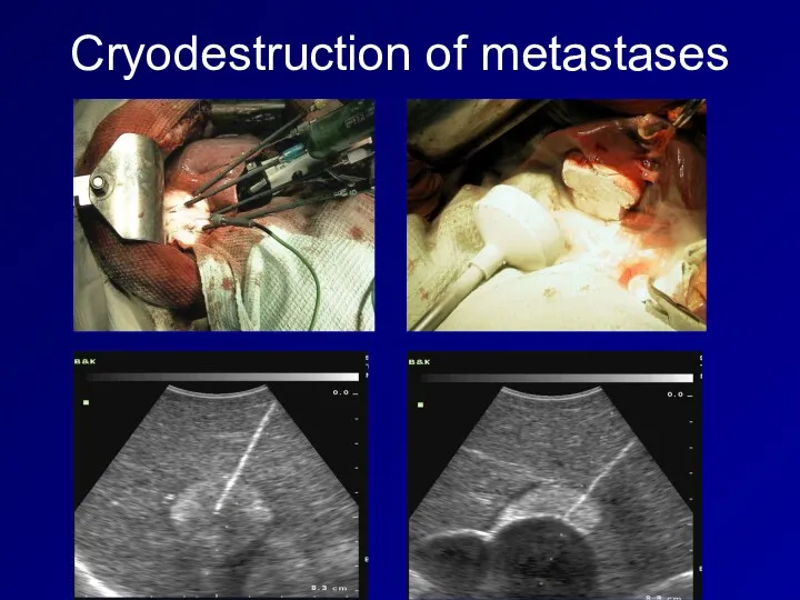 Cryodestruction of metastases
