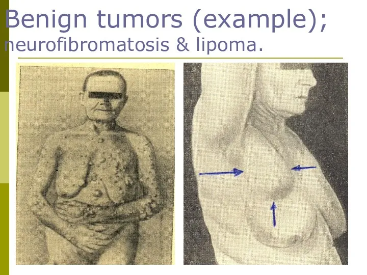 Benign tumors (example); neurofibromatosis & lipoma.