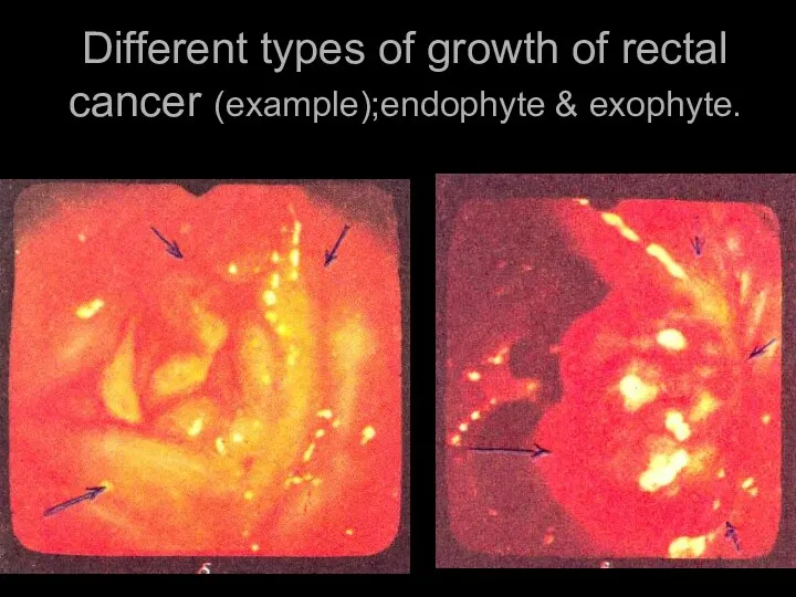 Different types of growth of rectal cancer (example);endophyte & exophyte.