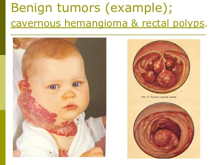 Benign tumors (example); cavernous hemangioma & rectal polyps.
