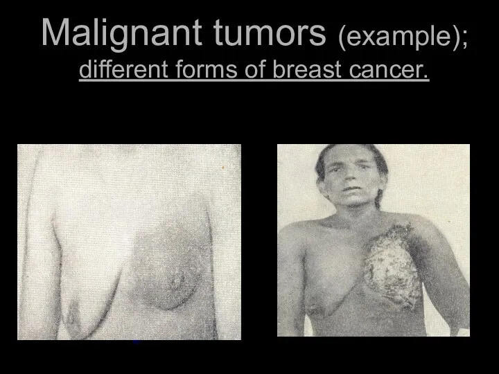Malignant tumors (example); different forms of breast cancer.