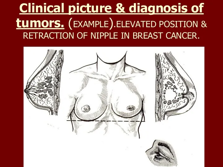 Clinical picture & diagnosis of tumors. (EXAMPLE).ELEVATED POSITION & RETRACTION OF NIPPLE IN BREAST CANCER.