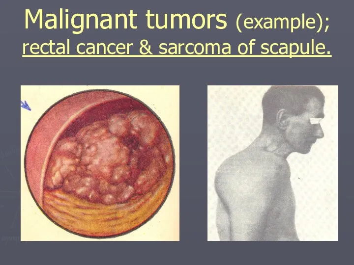 Malignant tumors (example); rectal cancer & sarcoma of scapule.