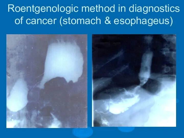 Roentgenologic method in diagnostics of cancer (stomach & esophageus)