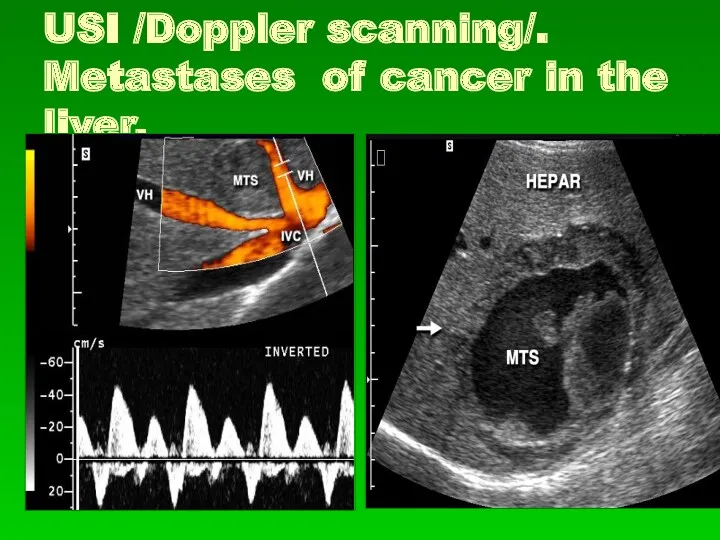 USI /Doppler scanning/. Metastases of cancer in the liver.