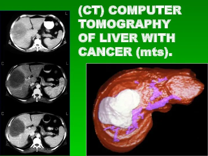 (CT) COMPUTER TOMOGRAPHY OF LIVER WITH CANCER (mts).