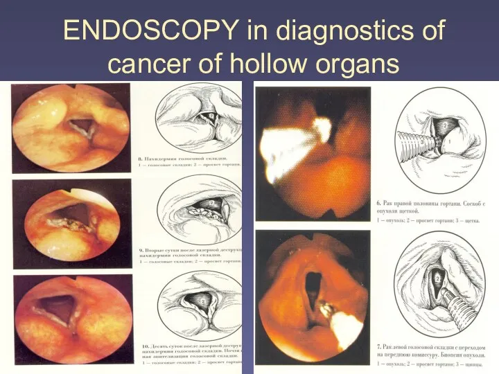 ENDOSCOPY in diagnostics of cancer of hollow organs