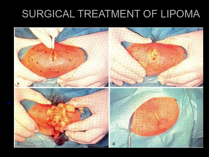 SURGICAL TREATMENT OF LIPOMA