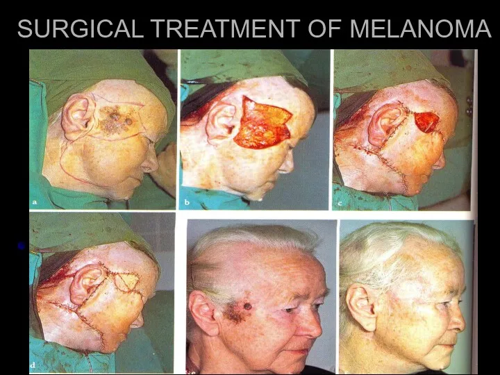 SURGICAL TREATMENT OF MELANOMA