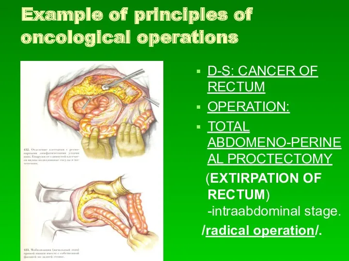Example of principles of oncological operations D-S: CANCER OF RECTUM OPERATION: TOTAL ABDOMENO-PERINEAL