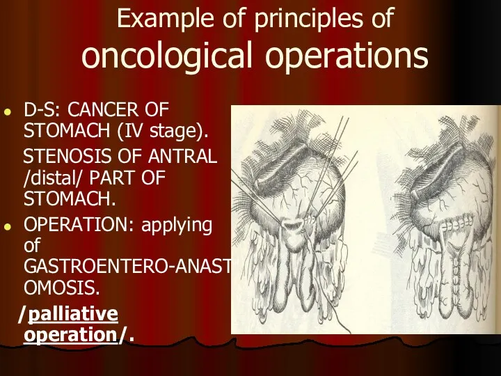 Example of principles of oncological operations D-S: CANCER OF STOMACH (IV stage). STENOSIS