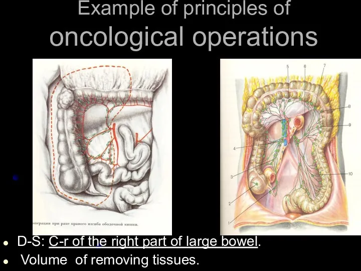 Example of principles of oncological operations D-S: C-r of the right part of