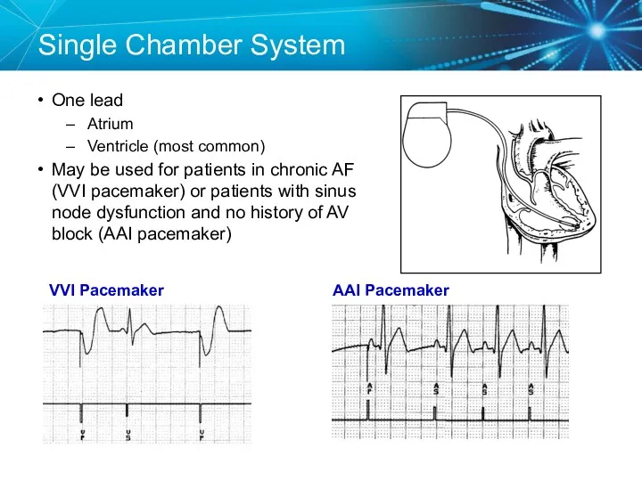Single Chamber System One lead Atrium Ventricle (most common) May