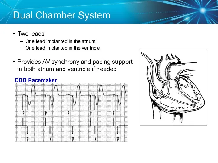 Dual Chamber System Two leads One lead implanted in the