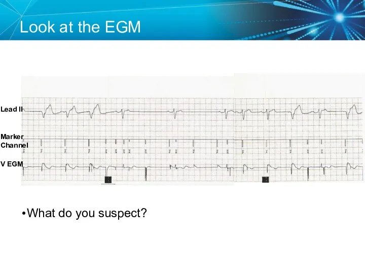 Look at the EGM What do you suspect? Lead II V EGM Marker Channel
