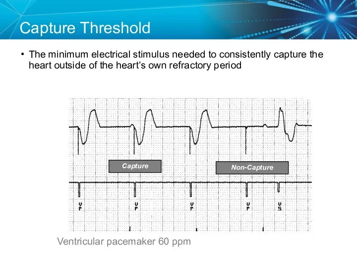 Capture Threshold The minimum electrical stimulus needed to consistently capture