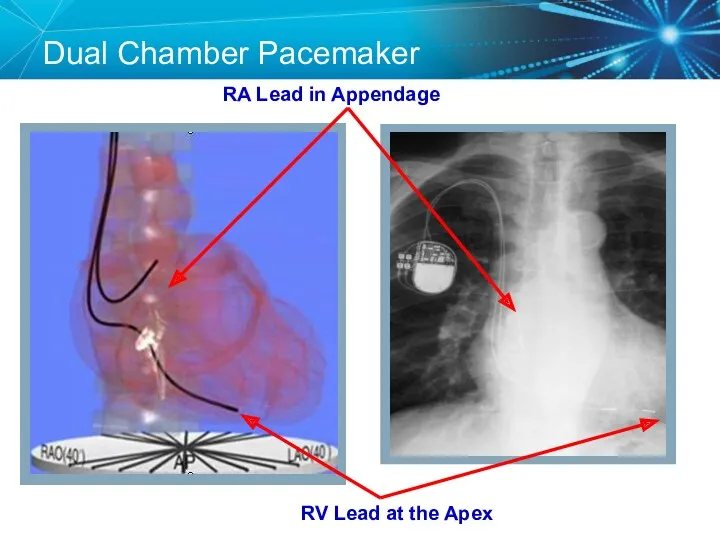 Dual Chamber Pacemaker RV Lead at the Apex RA Lead in Appendage
