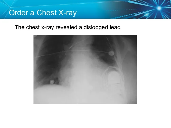 Order a Chest X-ray The chest x-ray revealed a dislodged lead